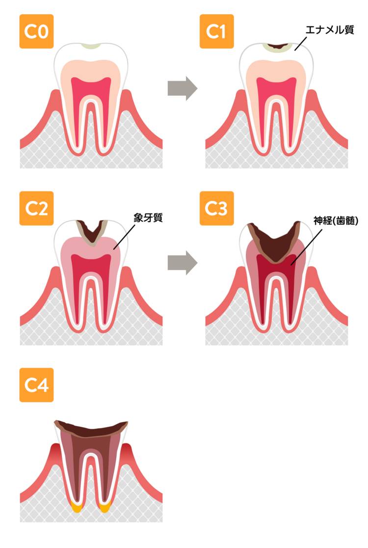 駒込駅前歯科クリニックが考えている、虫歯の進行度合いの図
