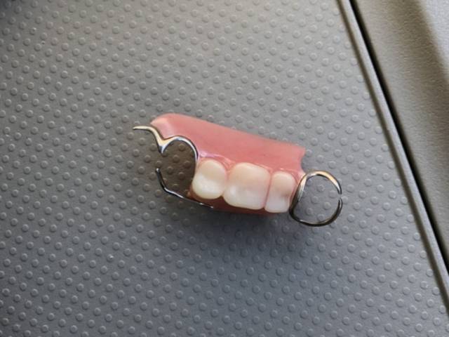 入れ歯（義歯）：部分入れ歯