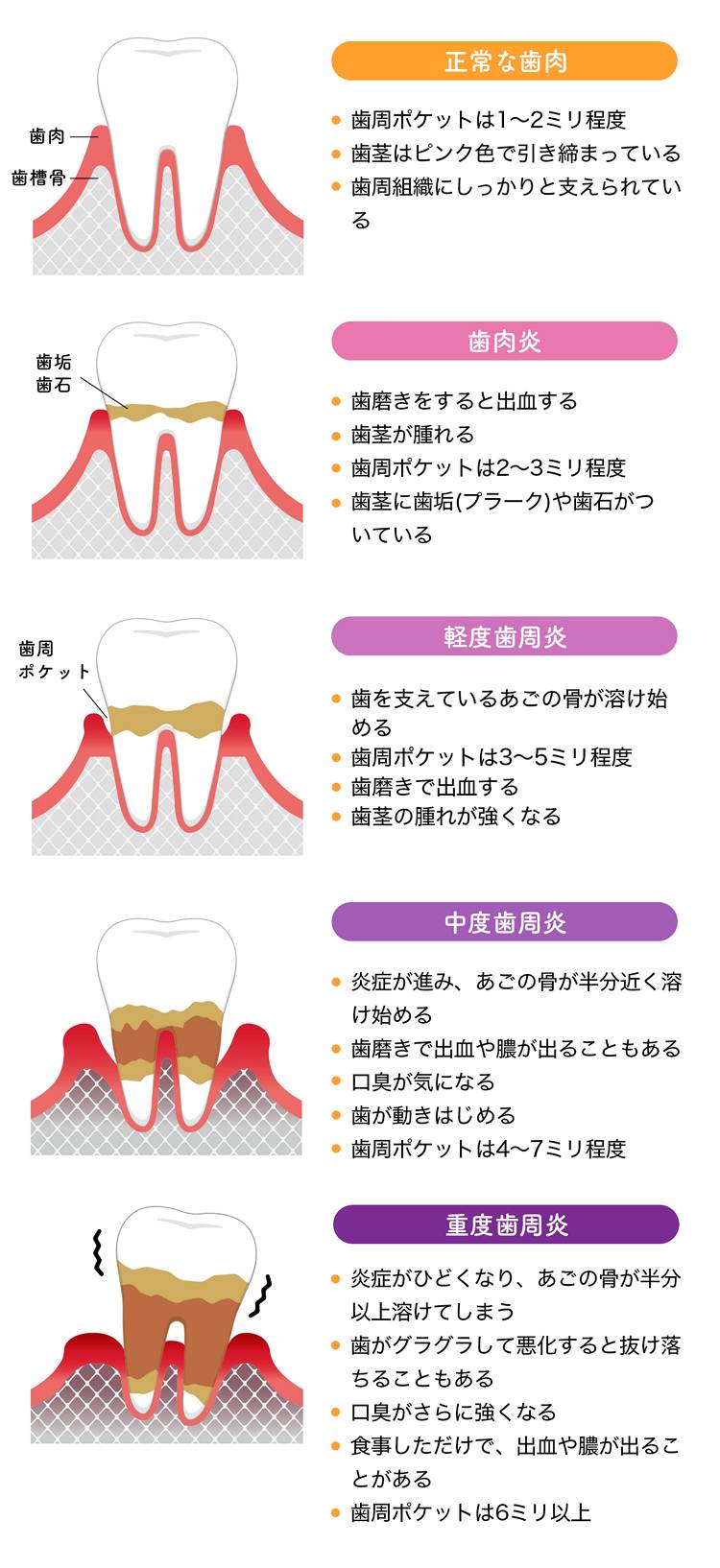 歯医者さんが考える歯周病の進行度合い