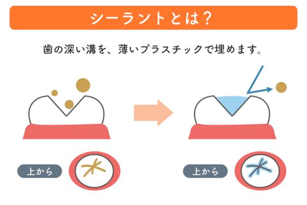 駒込の歯医者さんが考える、虫歯予防の図2